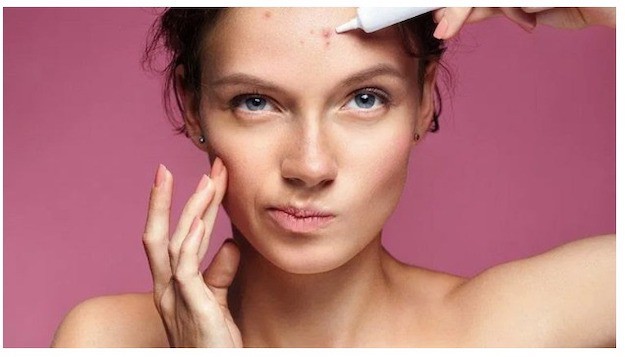 Easy Ways to Get Rid of Acne on Your Face